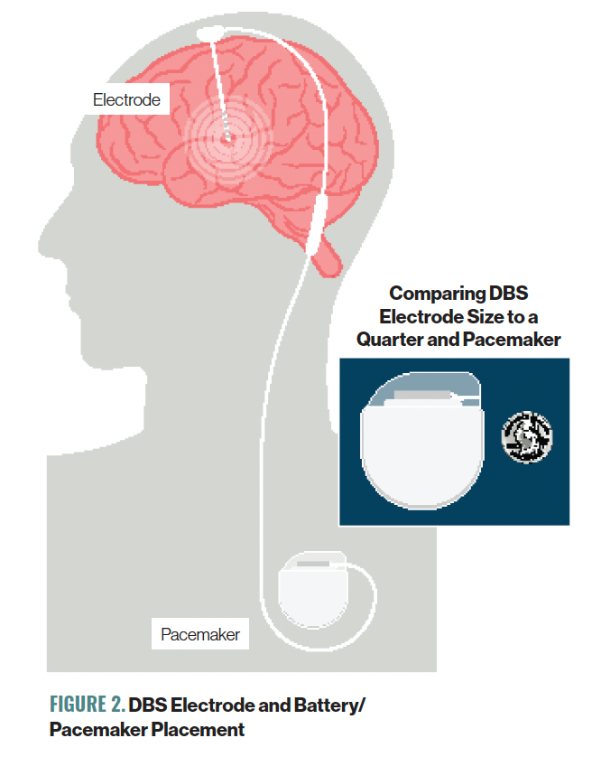 FIGURE 2. DBS Electrode and Battery/ Pacemaker Placement